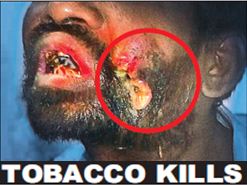 India 2011 Health Effects Mouth (Smokeless Tobacco Products) - diseased organ, gross